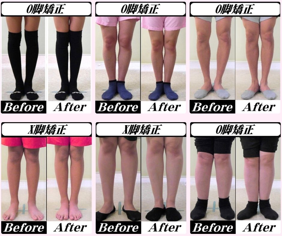 O脚・X脚矯正施術料