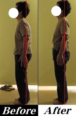 姿勢の矯正とカイロプラクティックの治療