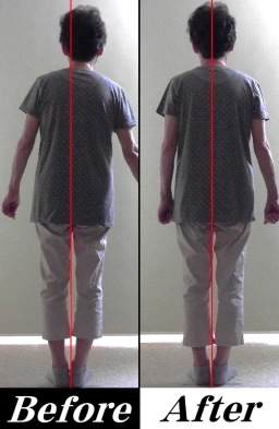 側弯症の改善方法